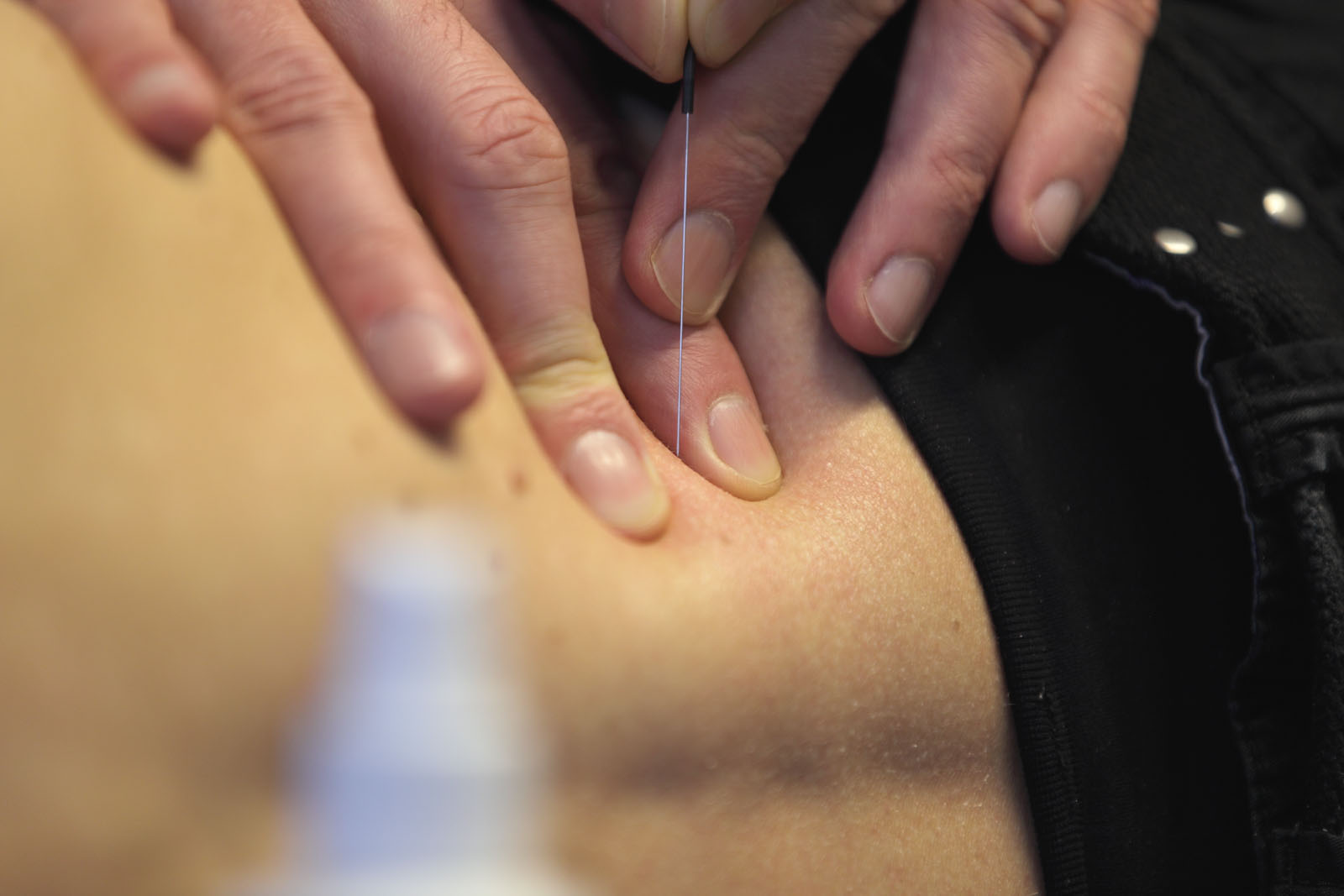 Dry Needling eines Triggerpunktes